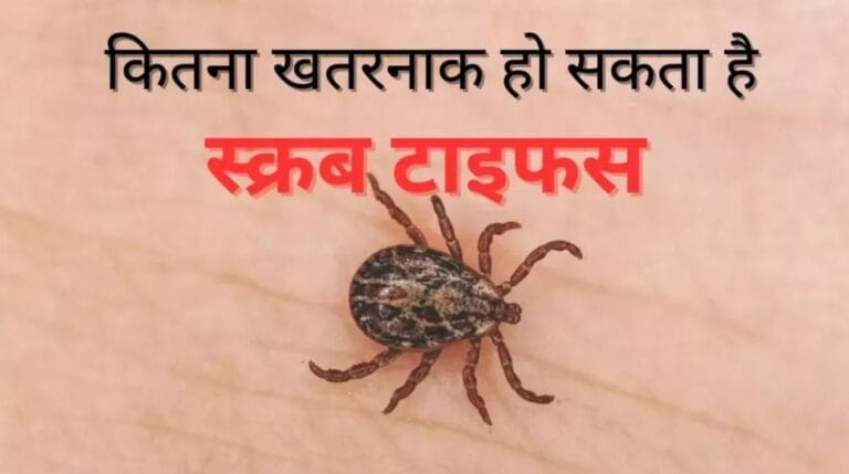 यमकेश्वर के 15 वर्षीय बच्चे में स्क्रब टायफस की पुष्टि, एम्स ऋषिकेश में हुआ सफल इलाज