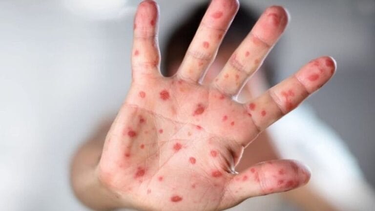 टोमेटो फ्लू उत्तराखंड